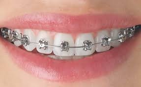 Orthodontic Alignment