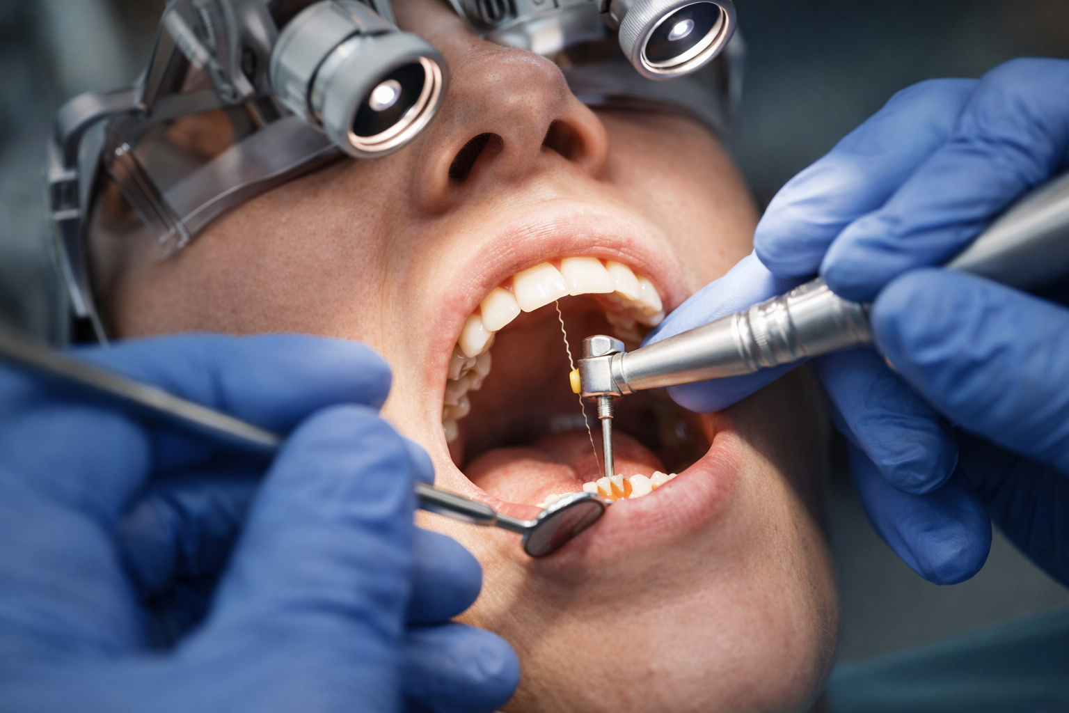 Root Canal Treatment